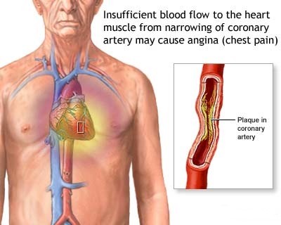 Chest Pain Why Does My Chest Hurt?