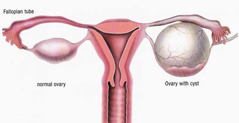 Normal Ovary and Ovarian Cyst Why Does my Ovary Hurt?