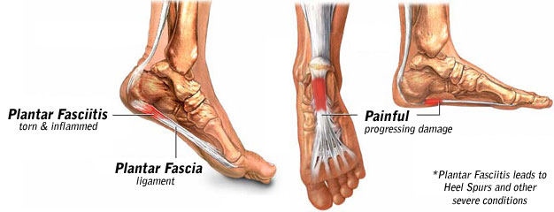 Plantar Fasciitis Why Does it Hurt So Much to Walk With Plantar Fasciitis?