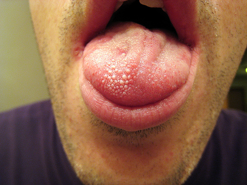 Genital Warts On Tongue