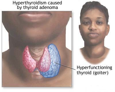 Thyroid infection Why Does My Voice Crack